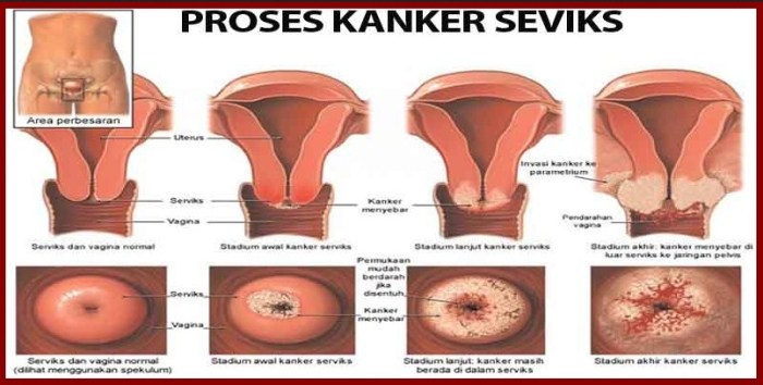 What square measure the symptoms of cervical cancer?